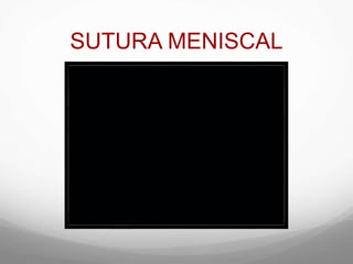 SUTURA MENISCAL
 
