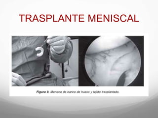 TRASPLANTE MENISCAL
 