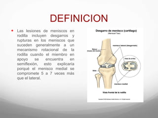 DEFINICION
 Las lesiones de meniscos en
rodilla incluyen desgarros y
rupturas en los meniscos que
suceden generalmente a un
mecanismo rotacional de la
rodilla cuando el miembro en
apoyo se encuentra en
semiflexión, esto explicaría
porqué el menisco medial se
compromete 5 a 7 veces más
que el lateral.
 