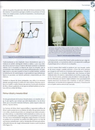 Traumatología
(sólo en los grados III puede estar indicado de forma transitoria el fija-
dor externo). El tratamiento quirúrgico estable en las primeras 2 4 horas
reduce las complicaciones y facilita el tratamiento y movilización pre-
coz del paciente.
Figura 30. Tracción 90°-90° para fracturas de fémur en el niño
Tradicionalmente se han empleado clavos intramedulares que se i n -
troducen en sentido anterógrado (desde la cadera), y para cuya intro-
ducción es necesario fresar el interior del hueso (aumentar su diámetro
interno). En la actualidad, se dispone de clavos no fresados, que se
recomiendan especialmente en pacientes politraumatizados c o n pato-
logía torácica asociada (cuando se fresa la cavidad medular, aumenta
la embolización de material graso, lo que puede ser especialmente pe-
ligroso en pacientes c o n función pulmonar comprometida por otros
motivos).
También se dispone de clavos retrógrados, m u y útiles si es necesario
abordar quirúrgicamente la rodilla por otros motivos (fracturas asocia-
das en la rodilla o rodilla flotante que precise el enclavado simultáneo
de tibia y fémur), pudiendo ser de especial utilidad también en las frac-
turas del tercio distal del fémur.
Fémur distal y meseta tibial
Se trata generalmente de fracturas intraarticulares y en miembro de car-
ga, lo que significa que siempre que estén desplazadas (y las de fémur
distal, por su frecuente extensión diafisaria), suelen requerir reducción
abierta y fijación interna.
Las fracturas de fémur distal (supracondíleas o supraintercondíleas de
fémur) suelen producirse en accidentes de tráfico de pacientes jóvenes
o en caídas casuales de pacientes con osteopenia por edad avanzada o
por otros motivos. La osteosíntesis tradicionalmente se realiza con una
placa o un tornillo-placa angulados, pero en la actualidad se usan cada
vez más clavos intramedulares retrógrados (especialmente si la fractura
se produce en un paciente c o n prótesis de rodilla previa o se trata de
una fractura extraarticular) y placas introducidas de forma percutánea,
utilizando técnicas de cirugía mínimamente invasiva (como las placas
LISS (Figura 31).
Las fracturas supracondíleas de fémur se tratan con placa y tornillos o clavo
intramedular retrógrado. No es infrecuente que ocurran en pacientes con
artroplastia de rodilla previa (fracturas periprotésicas). (a) La osteosíntesis
con placas colocadas mediante cirugía mínimamente invasiva (como las
placas LISS) proporcionan una buena recuperación funcional precoz (b)
Figura 3 1 . Fracturas supracondíleas de fémur
Las fracturas de la meseta tibial lateral suelen producirse por valgo for-
zado (típicamente, un traumatismo sobre la cara lateral de la rodilla por
el parachoques de un vehículo en un atropello).
Las de la meseta tibial medial se producen por varo forzado, suelen
ser de mayor energía y pueden asociarse a lesión del nervio peroneo
por elongación del mismo en el momento del traumatismo. Cuando la
superficie articular se encuentra desplazada, estas fracturas se tratan
mediante reducción abierta y osteosíntesis con tornillos y/o placa (Figu-
ra 32). C o n frecuencia, presentan zonas de defecto trabecular que de-
ben ser rellenadas con injerto o algún sustitutivo óseo que proporcione
soporte estructural. En fracturas m u y complejas, se opta por combinar
osteosíntesis con tornillos de los fragmentos articulares y neutralización
con un fijador externo semicircular asociado.
Figura 32. Fracturas de meseta tibial y transversa
de rótula tratadas con reducción y osteosíntesis
23
 