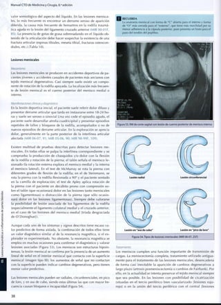 Manual CTO de Medicina y Cirugía, 8.a
edición
valor semiológico del aspecto del líquido. En las lesiones menisca-
les, lo más frecuente es encontrar un derrame seroso de aparición
diferida, la causa más frecuente de hemartros en la rodilla traumá-
tica aguda es la lesión del ligamento cruzado anterior (MIR 00-01 F,
85). La presencia de gotas de grasa sobrenadando en el líquido o b -
tenido de la articulación debe hacer sospechar la existencia de una
fractura articular (espinas tibiales, meseta tibial, fracturas osteocon-
drales, etc.) (Tabla 10).
Lesiones meniscales
Mecanismo
Las lesiones meniscales se producen en accidentes deportivos de pa-
cientes jóvenes y accidentes casuales de pacientes más ancianos con
tejido meniscal degenerativo. Casi siempre suele existir un c o m p o -
nente de rotación de la rodilla apoyada. La localización más frecuen-
te de lesión meniscal es el cuerno posterior del menisco medial o
interno.
Manifestaciones clínicas y diagnóstico
En la lesión deportiva inicial, el paciente suele referir dolor difuso y
presentar derrame articular q u e tarda en instaurarse entre 18-24 h o -
ras y suele ser seroso o sinovial Una vez cede el episodio agudo, el
paciente suele desarrollar atrofia cuadricipital y presentar episodios
repetidos de fallos y bloqueos de la rodilla, acompañados o no de
nuevos episodios de derrame articular. En la exploración se aprecia
dolor, generalmente en la parte posterior de la interlínea articular
afectada (MIR 06-07, 9 1 ; MIR 05-06, 9 0 ; MIR 98-99F, 109).
Existen m u l t i t u d de pruebas descritas para detectar lesiones m e -
niscales. En todas ellas se palpa la interlínea c o r r e s p o n d i e n t e y se
c o m p r u e b a la producción de chasquidos y/o d o l o r c o n la flexión
de la rodilla y rotación de la pierna; el talón señala el menisco le-
sionado (la rotación externa explora el menisco m e d i a l y la interna
el m e n i s c o lateral). En el test de M c M u r r a y se rota la pierna c o n
diferentes grados de flexión de la r o d i l l a ; en el de Steinmann, se
rota la pierna c o n la rodilla f l e x i o n a d a a 90° y el paciente sentado
en la c a m i l l a de exploración; el test de A p l e y aplica rotación de
la pierna c o n el paciente en decúbito p r o n o c o n compresión so-
bre el talón (que ocasionará d o l o r en las lesiones tanto meniscales
c o m o ligamentosas) o distracción de la pierna (que sólo ocasio-
nará d o l o r en las lesiones ligamentosas). Siempre debe valorarse
la p o s i b i l i d a d de lesión asociada de los ligamentos de la rodilla
(especialmente el l i g a m e n t o colateral medial y el c r u z a d o anterior,
en el caso de las lesiones del menisco m e d i a l [tríada desgraciada
de O ' D o n o g h u e ] ) .
A u n q u e cada u n o de los síntomas y signos descritos tiene escaso va-
lor predictivo de forma aislada, la combinación de todos ellos tiene
un valor diagnóstico similar al de la resonancia magnética, si el ex-
plorador es experimentado. N o obstante, la resonancia magnética se
emplea en muchas ocasiones para confirmar el diagnóstico y valorar
lesiones asociadas (Figura 53). Los meniscos son estructuras hipoin-
tensas; la lesión meniscal se confirma por la presencia de un aumento
lineal de señal en el interior meniscal que contacta con la superficie
meniscal (imagen tipo III); los aumentos de señal que no contactan
con la superficie pueden indicar cambios degenerativos, pero tienen
menor valor predictivo.
Las lesiones meniscales pueden ser radiales, circunferenciales, en pico
de loro, y en asa de cubo, siendo estas últimas las que con mayor fre-
cuencia causan bloqueos e incapacidad (Figura 54).
Q R E C U E R D A
La anatomía meniscal c o n f o r m a de " C " abierta para el interno y f o r m a
de " O " más cerrada para el " e x t e r n o " , q u e tiene más m o v i l i d a d por su
menor adherencia a la cápsula posterior, pues presenta un hiato para el
paso del tendón del poplíteo.
Figura 53. RM de corte sagital con lesión de cuerno posterior de menisco interno
Lesión en "asa de cubo" Lesión en "pico de loro"
Figura 54. Tipos de lesiones meniscales (MIR 06-07,237)
Tratamiento
Los meniscos c u m p l e n una función importante de transmisión de
cargas. La meniscectomía c o m p l e t a , tratamiento u t i l i z a d o antigua-
mente para el tratamiento de las lesiones meniscales, desencadena
de f o r m a casi inevitable la aparición de cambios degenerativos a
largo plazo (artrosis posmeniscectomía o cambios de Fairbank). Por
ello, en la actualidad se intenta preservar el t e j i d o meniscal siempre
que sea posible. En las lesiones c o n p o s i b i l i d a d de cicatrización
(situadas en el tercio periférico bien vascularizado [lesiones rojo-
rojo] o en la unión del tercio periférico c o n el central [lesiones
3 8
 