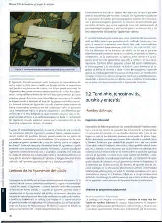 Manual CTO de Medicina y Cirugía, 8.a
edición
Figura 57. Semitendinoso-Recto interno preparado para su inserción
Ligamento cruzado posterior, ligamento colateral lateral
e inestabilidad posterolateral
El ligamento cruzado posterior suele lesionarse en traumatismos d i -
rectos sobre la tibia con la rodilla en flexión (similar al mecanismo
que produce una luxación de cadera, con la que puede asociarse). Se
diagnostica detectando excesivo desplazamiento de la tibia hacia pos-
terior, con la rodilla en flexión de 90° (test del cajón posterior). En casos
crónicos, puede detectarse una deformidad en recurvatum (la rodilla
se hiperextiende al no existir el tope del ligamento cruzado posterior).
Las lesiones aisladas del ligamento cruzado posterior suelen tratarse de
forma conservadora (potenciación del cuadríceps), salvo en pacientes
cuya inestabilidad impida la práctica deportiva o con diferencias por
encima de 8-10 m m , forzando el cajón posterior, en cuyo caso se e m -
plean plastias similares a las del cruzado anterior. En la reconstrucción
del ligamento cruzado posterior, parece que la reconstrucción de dos
fascículos proporciona mejores resultados.
Cuando la inestabilidad posterior se asocia a lesión de una o más de
las estructuras laterales (ligamento colateral lateral, cápsula postero-
lateral, tendón del poplíteo, bíceps), puede producirse un patrón de
inestabilidad posterolateral más invalidante. En la exploración de estos
pacientes se aprecia aumento de la rotación externa pasiva y cajón pos-
terolateral. Suele ser necesario reconstruir tanto el ligamento cruzado
posterior c o m o las estructuras laterales lesionadas. La lesión aislada del
ligamento colateral lateral es rara, y cuando es completa, está indicada
la cirugía de entrada; se caracteriza por dolor e inestabilidad al forzar el
varo, puede asociarse a lesiones del peroneo y obliga a descartar lesión
asociada del ligamento cruzado posterior y luxación de rodilla.
Lesiones de los ligamentos del tobillo
Los esguinces de tobillo son lesiones extremadamente frecuentes. En la
mayoría de los centros sanitarios constituyen la urgencia traumatológi-
ca más frecuente. El ligamento colateral medial o deltoideo raramente
se lesiona de forma aislada, y cuando un paciente presenta dolor y
tumefacción en la cara medial del tobillo, es necesario descartar una
fractura de peroné proximal asociada mediante una adecuada explora-
ción física y la obtención de radiografías simples en las que se visualice
el peroné en toda su longitud (por la posibilidad de que se haya produ-
cido una fractura de Maisonneuve). El término esguince de tobillo se
aplica a las lesiones del complejo ligamentoso lateral.
Generalmente se trata de accidentes deportivos en los que el paciente
sufre un traumatismo por inversión forzada. Los ligamentos situados en
la cara lateral del tobillo (peroneoastragalino anterior, peroneocalcá-
neo y peroneoastragalino posterior) se lesionan secuencialmente por
ese orden, de forma que, en los esguinces leves, sólo está lesionado el
peroneoastragalino anterior, y en los más graves, se lesionan dos o los
tres componentes del complejo ligamentoso externo.
El paciente habitualmente refiere que, en el momento del traumatismo,
notó un dolor brusco que posteriormente cedió de forma casi c o m -
pleta, y comenzó a aumentar unas horas más tarde, manteniéndose
de forma continua desde entonces (MIR 00-01, 86; MIR 99-00F, 105).
Esto los diferencia de las fracturas de tobillo, en las que el paciente
experimenta dolor continuo desde el accidente, sin periodo de latencia
asintomático. En la exploración, se aprecia dolor selectivo a la pal-
pación en el trayecto ligamentoso asociado a edema y, en ocasiones,
equimosis. También deben palparse la base del quinto metatarsiano,
el músculo pedio y la articulación de Lisfranc, para diferenciar el es-
guince de tobillo de lesiones a otros niveles. El tratamiento consiste en
aplicar las medidas generales expuestas en el apartado de introducción
(vendaje compresivo, reposo, elevación, frío local y antiinflamatorios),
añadiendo la inmovilización con férula, yeso, o tobillera estabilizadora
en los casos con mayor tumefacción e impotencia funcional.
3.2.Tendinitis, tenosinovitis,
bursitis y entesitis
Hombro doloroso
Diagnóstico diferencial
Los cuadros de dolor originados en las partes blandas del hombro consti-
tuyen uno de los motivos de consulta más frecuentes de la especialidad.
La valoración del paciente con un hombro doloroso debe tratar de dis-
tinguir en cuál de los diferentes procesos se encuadra. En primer lugar,
deben descartarse procesos que causen dolor referido o irradiado hacia
el hombro. Existe una gran variedad de procesos viscerales que pueden
causar dolor referido (isquemia miocárdica, úlcera gastroduodenal, esofa-
gitis, etc.). Además, es muy frecuente que los pacientes con patología de la
columna cervical refieran dolor en el hombro; debe sospecharse patología
cervical en pacientes con dolor en la zona superior del hombro y sinto-
matología radicular. Una adecuada exploración y la realización de radio-
grafías simples de columna cervical permiten confirmar el diagnóstico. Si
se determina que el dolor procede del hombro, el siguiente paso es des-
cartar patología en la articulación glenohumeral (artrosis, enfermedades
inflamatorias, osteonecrosis, secuelas de fracturas, neoplasias, etc.), cuyo
tratamiento se expone en el Capítulo 7 dedicado a Cirugía reconstructiva
del adulto. Sin embargo, lo más frecuente es que el dolor se deba a alguno
de los siguientes cuatro procesos de las partes blandas periarticulares.
Síndrome de atrapamiento subacromial
Recuerdo anatómico y fisiopatología
La patología del espacio subacromial constituye la causa más fre-
cuente de hombro doloroso. El espacio subacromial es el compren-
dido entre la articulación glenohumeral, interiormente, y el arco cora-
coacromial superiormente. D i c h o arco está formado por el acromion,
4 0
 