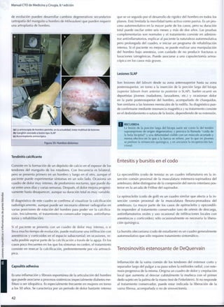 Manual CTO de Medicina y Cirugía, 8.a
edición
de evolución pueden desarrollar cambios degenerativos secundarios
(artropatía del manguito u hombro de Milwaukee) que pueden requerir
una artroplastia de hombro.
(a) La artroscopia de hombro permite, en la actualidad, tratar multitud de lesiones
(b) Ganglión asociado a lesión tipo SLAP
(c) Acromioplastia artroscópica
Figura 59. H o m b r o doloroso
Tendinitis calcificante
Consiste en la formación de un depósito de calcio en el espesor de los
tendones del manguito de los rotadores. Con frecuencia es bilateral,
pero se presenta primero en un hombro y luego en el otro, aunque el
paciente puede experimentar síntomas en un solo lado. Ocasiona un
cuadro de dolor m u y intenso, de predominio nocturno, que puede d u -
rar entre unos días y varias semanas. Después, el dolor mejora progresi-
vamente hasta desaparecer, aunque su duración total es m u y variable.
El diagnóstico de este cuadro se confirma al visualizar la calcificación
radiológicamente, aunque puede ser necesario obtener radiografías en
varias posiciones de rotación del hombro para poder ver la calcifica-
ción. Inicialmente, el tratamiento es conservador (reposo, antiinflama-
torios y rehabilitación).
Si el paciente se presenta con un cuadro de dolor muy intenso, o si
lleva m u c h o tiempo de evolución, puede realizarse una infiltración c o n
anestésicos y corticoides en el espacio subacromial; en ocasiones, re-
sulta posible aspirar parte de la calcificación a través de la aguja. En los
casos poco frecuentes en los que los síntomas no ceden, el tratamiento
consiste en resecar la calcificación, preferentemente por vía artroscó-
pica.
Capsulitis adhesiva
Es una inflamación y fibrosis espontánea de la articulación del hombro
que puede asociarse a procesos sistémicos (especialmente diabetes me-
1
1 ¡tus) o ser idiopática. Es especialmente frecuente en mujeres en torno
a los 50 años. Se caracteriza por un periodo de dolor bastante intenso
que se ve seguido por el desarrollo de rigidez del hombro en todos los
planos. Está limitada la movilidad tanto activa c o m o pasiva. Es un pro-
ceso autorresolutivo en la mayor parte de los casos, pero su duración
total puede oscilar entre seis meses y más de dos años. Las pruebas
complementarias son normales y el tratamiento consiste en adminis-
trar antiinflamatorios, explicar al paciente la naturaleza autorresolutiva
pero prolongada del cuadro, e iniciar un programa de rehabilitación
intensa. Si el paciente no mejora, se puede realizar una manipulación
del hombro bajo anestesia, con cuidado de no producir fracturas o
luxaciones iatrogénicas. Puede asociarse a una capsulectomía artros-
cópica en los casos más graves.
Lesiones SLAP
Son lesiones del labrum desde su zona anterosuperior hasta su zona
posterosuperior, en torno a la inserción de la porción larga del bíceps
(superior labrum from anterior to posterior o SLAP). Suelen ocurrir en
deportistas jóvenes (nadadores, lanzadores, etc.) y ocasionan dolor
en la parte posterosuperior del hombro, acompañado de chasquidos.
Son similares a las lesiones meniscales de la rodilla. Su diagnóstico pue-
de confirmarse mediante resonancia magnética y su tratamiento consiste
en el desbridamiento o sutura de la lesión, dependiendo de su extensión.
Q R E C U E R D A
La lesión de la porción larga del bíceps suele ser c o m o la del tendón
supraespinoso de origen degenerativo, y provoca la llamada "caída de
la bola b i c i p i t a l " y una d e f o r m i d a d visible c o n u n músculo acortado y
menos efectivo en lo q u e a la fuerza se refiere, p o r lo q u e en jóvenes
se prefiere la reinserción quirúrgica, y en ancianos la recuperación f u n -
cional.
Entesitis y bursitis en el codo
La epicondilitis (codo de tenista) es un cuadro inflamatorio en la i n -
serción común proximal de la musculatura extensora-supinadora del
antebrazo; debe distinguirse de la compresión del nervio interóseo pos-
terior en la arcada de Fróhse del supinador.
La epitrocleítis (codo de golf) es un cuadro similar que afecta a la i n -
serción común proximal de la musculatura flexora-pronadora del
antebrazo. La mayor parte de los casos de epitrocleítis y epicondili-
tis responden al tratamiento conservador (uso de ortesis de descarga,
antiinflamatorios orales y uso ocasional de infiltraciones locales con
anestésicos y corticoides); sólo ocasionalmente es necesaria la libera-
ción quirúrgica.
La bursitis olecraniana (codo de estudiante) es un cuadro generalmente
autorresolutivo que sólo requiere tratamiento sintomático.
Tenosinovitis estenosante de DeQuervain
Inflamación de la vaina común de los tendones del extensor corto y
separador largo del pulgar a su paso sobre la estiloides radial, con este-
nosis progresiva de la misma. Origina un cuadro de dolor y crepitación
local que aumenta al desviar cubitalmente la muñeca con el primer
dedo sujeto en la palma de la mano (test de Finkelstein). Si no responde
al tratamiento conservador, puede estar indicada la liberación de la
vaina fibrosa, acompañada o no de sinovectomía.
4 2
 