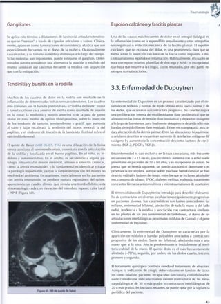 Traumatología
Gangliones
Se aplica este término a dilataciones de la sinovial articular o tendino-
sa que se "hernian" a través de cápsulas articulares y vainas. Clínica-
mente, aparecen c o m o tumoraciones de consistencia elástica que son
especialmente frecuentes en el dorso de la muñeca. Ocasionalmente
causan dolor, y su tamaño aumenta y disminuye a lo largo del tiempo.
Si las molestias son importantes, puede extirparse el ganglión. Deter-
minados autores consideran una alternativa la punción o estallido del
mismo, siendo en ese caso más frecuente la recidiva con la punción
que con la extirpación.
Tendinitis y bursitis en la rodilla
M u c h o s de los cuadros de dolor en la rodilla son resultado de la
inflamación de determinadas bolsas serosas o tendones. Los cuadros
más comunes son la bursitis prerrotuliana o "rodilla de beata" (dolor
y tumefacción en cara anterior de rodilla c o m o resultado de presión
en la zona); la tendinitis y bursitis anserina o de la pata de ganso
(dolor en zona medial de epífisis tibial proximal, sobre la inserción
de los tendones de sartorio, semitendinoso y grácil, que aumenta
al subir y bajar escaleras); la tendinitis del bíceps femoral; la del
poplíteo, y el síndrome de fricción de la bandeleta iliotibial sobre el
epicóndilo femoral.
El quiste de Baker (MIR 06-07, 256) es una dilatación de la bolsa
serosa asociada al semimembranoso, conectada c o n la articulación
de la rodilla y localizada en el hueco poplíteo. En el niño, es i n -
d o l o r o y autorresolutivo. En el adulto, es secundario a alguna pa-
tología intraarticular (lesión meniscal, artrosis o sinovitis crónicas,
c o m o la artritis reumatoide), y lo fundamental es identificar y tratar
la patología responsable, ya q u e la simple extirpación del m i s m o no
resolverá el p r o b l e m a . En ocasiones, especialmente en los pacientes
con artritis reumatoide, se produce ruptura espontánea del quiste,
apareciendo un cuadro clínico que simula una tromboflebitis; esta
sintomatología cede c o n elevación del m i e m b r o , reposo, calor local
y AINE (Figura 60).
Figura 60. RM de quiste de Baker
Espolón calcáneo y fascitis plantar
Una de las causas más frecuentes de dolor en el retropié (talalgia) es
la inflamación (como en la espondilitis anquilosante y otras artropatías
seronegativas) o irritación mecánica de la fascitis plantar. El espolón
calcáneo, que no es causa del dolor, es una prominencia ósea que se
forma sobre la inserción calcánea de la fascia c o m o respuesta a mi-
crotraumatismos repetidos e inflamación. Habitualmente, el cuadro se
trata con reposo relativo, plantillas de descarga y AINE; es excepcional
que haya que recurrir a la cirugía, cuyos resultados, por otra parte, no
siempre son satisfactorios.
3.3. Enfermedad de Dupuytren
La enfermedad de Dupuytren es un proceso caracterizado por el de-
sarrollo de nodulos y bandas de tejido fibroso en la fascia palmar y de
los dedos, que ocasionan su contractura progresiva. Se caracteriza por
una proliferación intensa de miofibroblastos (fase proliterativa) que se
alinean con las líneas de tensión (fase involutiva) y depositan colágeno
a lo largo de las mismas, para finalmente desaparecer dejando sólo esas
bandas de tejido fibroso (fase residual). Existe microangiopatía asocia-
da y afectación de la dermis palmar. Entre las alteraciones bioquímicas
y celulares descritas se encuentran aumento de la relación colágeno 111/
colágeno I y aumento de la concentración de ciertos factores de creci-
miento (FGF-2, PDGF y TGF-B).
Esta enfermedad es casi exclusiva en la raza caucasiana, más frecuente
en varones (de 7 a 15 veces), y su incidencia aumenta con la edad (suele
presentarse en pacientes de 50 a 60 años, y es excepcional en niños). Se
piensa que se hereda siguiendo un patrón autosómico dominante con
penetrancia incompleta, aunque sobre esa base heredofamiliar se han
descrito múltiples factores de riesgo, entre los que se incluyen alcoholis-
mo, consumo de tabaco, EPOC, diabetes mellitus, epilepsia, tratamiento
con ciertos fármacos anticonvulsivos y microtraumatismos de repetición.
El término diátesis de Dupuytren se introdujo para describir el desarro-
llo de contracturas en diversas localizaciones rápidamente progresivas
en pacientes jóvenes. Sus características son fuertes antecedentes fa-
miliares, enfermedad bilateral, afectación de toda la mano o del lado
radial, tendencia a la recidiva y asociación con contracturas similares
en las plantas de los pies (enfermedad de Lederhose), el dorso de las
articulaciones interfalángicas proximales (nodulos de Garrod) y el pene
(enfermedad de Peyronie).
Clínicamente, la enfermedad de D u p u y t r e n se caracteriza p o r la
aparición de nodulos y bandas palpables asociados a contractura
progresiva de los dedos. Suele ser bilateral, afectando más a una
m a n o q u e a la otra. Afecta p r e d o m i n a n t e e i n i c i a l m e n t e al terri-
torio cubital de la m a n o . El q u i n t o d e d o es el más frecuentemente
afectado ( - 7 0 % ) , seguido, por o r d e n , de los dedos cuarto, tercero,
p r i m e r o y segundo.
El tratamiento quirúrgico continúa siendo el tratamiento de elección.
Aunque la indicación de cirugía debe valorarse en función de facto-
res c o m o edad del paciente, incapacidad funcional y comorbilidades,
suele considerarse indicada cuando existen contracturas de las meta-
carpofalángicas de 30 o más grados o contracturas interfalángicas de
20 o más grados. En los casos restantes, se puede optar por la vigilancia
periódica del paciente.
43
 