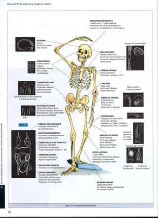 Manual CTO de Medicina y Cirugía, 8.a
edición
GRANULOMA EOSINÓFILO
Cráneo, Axial < 10 años. Maligno
Histiocitosis de células de Langerhans
Lesiones en "sacabocados", vértebra plana
OSTEOMA
Cráneo
20-30 años. Lesión
ósea madura
HEMANGIOMA
Cráneo y raquis
(cuerpo)
40-60 años. Vascular
Tto.: curetaje
o radioterapia
CONDROSARCOMA
Cinturas y axial 
30-60 años. Maligno
radiorresistente y
quimiorresistente
Calcificaciones en "sal y pimienta"
o "palomitas de maíz"
Nidus
Lesiones en "sacabocados"
MIELOMA ÓSEO
Cráneo, raquis (ant.)...
40-60 años.Tumor maligno más |
frecuente. Osteoporosis (activa
osteoclastos)
OSTEOBLASTOMA
Raquis (posterior)
20-30 años. Benigno > 2 cm
mi
OSTEOMA OSTEOIDE
Femorotibial. Raquis (post.)
20-30 años. Benigno. Frecuente.
Osteoblástico. Dolor NOCTURNO
que cede con ASPIRINA
FIBROMA NO OSIFICANTE
8-20 años. DESAPARECE
en la adolescencia
QUISTE ANEURISMÁTICO
8-20 años. Contenido hemático
Dolor asociado a trauma
TUMOR DE CÉLULAS GIGANTES
20-40 años. MUJERES
Aumenta en el embarazo
Puede metastatizar (pulmón < 5%)
CONDROBLASTOMA
5-25 años. Cartilaginoso
Aspecto "algodonoso"
QUISTE ÓSEO ESENCIAL
5-20 años. Curación espontánea
OSTEOCONDROMA
Durante CRECIMIENTO
Tumor óseo más frecuente
Síndromes de compresión
Maligniza < 0 , 1 % (Figura 75)
CORDOMA
Sacro, divus
40-70 años. Maligno
Restos notocorda
DISPLASIA FIBROSA
Costillas, fémur...
Niñas. Se asocia
a síndromes
endocrinos (S. Albright)
ENCONDROMA
Falanges de la mano (90%)
20-30 años. Benigno
Múltiples en: E. Ollier, E. Maffucci
Malignizan 2 % ( 1 0 % si múltiples)
Deformidad en
"cayado de pastor"
/
SARCOMA DE EWING
Diáfisis femoral
10-15 años. Maligno
RADIOSENSIBLE
Tumor óseo maligno
Más frecuente niño
OSTEOSARCOMA
> 5 0 % rodilla
10-25 años y 50-60 años. Maligno
osteolítlco o condénsame
Metástasis pulmonares (98%)
Aposición
perióstica
en "capas
de cebolla
'Triángulo de Codman
Imagen de
"sol naciente"
Imagen de
"fuego en hierba"
ADAMANTIMOMA
Diáfisis tibial (90%)
20-50 años. Maligno. Radiolúcido
en "pompa de jabón"
Figura 79. Principales tumores óseos
6 0
 