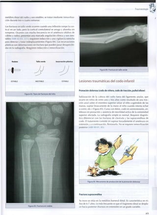 Traumatología
metáfisis distal del radio y son estables; se tratan mediante inmoviliza-
ción durante tres o cuatro semanas.
Las fracturas en tallo verde ocurren cuando una inflexión rompe la cor-
tical en un lado, pero la cortical contralateral se arruga y abomba sin
romperse. Ocurren con mucha frecuencia en el antebrazo (diáfisis de
cubito y radio), presentan una marcada angulación clínica y son ines-
tables (MIR 02-03, 221); requieren reducción y una vigilancia estrecha
para detectar y tratar redesplazamientos (Figura 84). Las incurvaciones
plásticas son deformaciones sin fractura que pueden pasar desapercibi-
das en la radiografía. Requieren reducción e inmovilización.
Rodete Tallo verde Incurvación plástica
ESTABLE INESTABLE ESTABLE
Figura 82. Tipos de fracturas del niño
Figura 83. Fractura e n rodete
Figura 84. Fractura en tallo verde
Lesiones traumáticas del codo infantil
Pronación dolorosa (codo de niñera, codo de tracción, pulled elbow)
Subluxación de la cabeza del radio fuera del ligamento anular, que
ocurre en niños de entre u n o y tres años c o m o resultado de una trac-
ción axial sobre el miembro superior (alzar al niño cogiéndole de las
manos, sujetar bruscamente de la mano al niño cuando intenta echar
a correr, etc.) (Figura 85). Cursa c o n dolor, codo en semiextensión, a n -
tebrazo en pronación y ausencia de movilidad activa de la extremidad
superior afectada. La radiografía simple es normal. Requiere diagnós-
tico diferencial con las fracturas de clavícula y las supracondíleas de
codo. El tratamiento consiste en supinar forzadamente el antebrazo en
extensión, y a continuación, flexionarlo. N o se requiere inmovilización
posterior (MIR 00-01, 8 5 ) .
Figura 85. Mecanismo d e producción de la pronación dolorosa
Fractura supracondílea
Su trazo se sitúa en la metáfisis humeral distal. Es característica en n i -
ños de 6-7 años. Lo más frecuente es que el fragmento distal se despla-
ce hacia posterior (fractura en extensión) en un grado variable.
(53
 