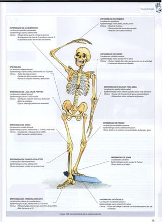 Traumatología
ENFERMEDAD DE SCHEUERMANN
Localización: platillos vertebrales
Epidemiología: varón, adolescente
Clínica: • Cifosis dorsal que no corrige la postura
• Acuñamiento de más de 3 vértebras, más de 5
• Tratamiento antes del fin del crecimiento
EPIFISIÓLISIS
Localización: cabeza femoral
Epidemiología: varón (70%), adolescente (10-15 años)
Clínica: • Dolor de cadera, cojera
• Limitación de la rotación interna
• Pierna en rotación externa y abducción
ENFERMEDAD DE LEGG-CALVÉ-PERTHES
Localización: cabeza femoral
Epidemiología: varón (75%), escolar
Clínica: • Limitación rotación interna y abducción
• Marcha antiálgica
• Típico: talla baja (edad ósea retardada)
ENFERMEDAD DE KONIG
Localización: cóndilo femoral
Epidemiología:varón,adolescente (> 21 años, mala evol
Clínica: • Crepitación y bloqueo de la rodilla
• Más frecuente cóndilo interno
ENFERMEDAD DE OSGOOD-SCHLATTER
Localización:tuberosidad tibial
Epidemiología: varón, adolescente
Clínica: hinchazón y dolor a la presión local
ENFERMEDAD DE KIENBÓCK
Localización: semilunar
Epidemiología: varón (80%), adulto joven
Clínica: • Dolor de muñeca
• Disminución de fuerza de prensión
• Relación con cubitus minimus
ENFERMEDAD DE PANNER
Localización: cóndilo humeral
Epidemiología: varón, escolar (4-10 años)
Clínica: • Dolor y rigidez del codo, que aumenta con la actividad
• Limitación dolorosa a la flexión
ENFERMEDAD DE BLOUNT (TIBIA VARA)
Localización: platillo tibial medial
Epidemiología: varón, infantil y adulto joven (más benigno)
Clínica: • Causa más frecuente de genu varo patológico
• Bilateral en niños, unilateral en jóvenes
ENFERMEDAD DE PREISER
Localización: escafoides carpiano
Epidemiología: varón, adolescente/joven
Clínica: dolor en la muñeca con actividades de fuerza y giros
ENFERMEDAD DESEVER
Localización: calcáneo
Epidemiología: varón, escolar (6-7 años)
Clínica: dolor en el talón
ENFERMEDAD DE FREIBERG (KOHLER II)
Localización: cabeza de metatarsianos
Epidemiología: mujer, adolescente (12-15 años)
Clínica: • Metatarsalgia anterior, que aumenta de puntillas
• Más frecuente el 2.°
ENFERMEDAD DE KOHLER (I)
Localización: escafoides tarsiano
Epidemiología: varón, infantil (2-9 años)
Clínica: • Dolor que obliga a caminar con el borde externo del pie
• Unilateral
Figura 104. Características de la osteocondrosis
75
 