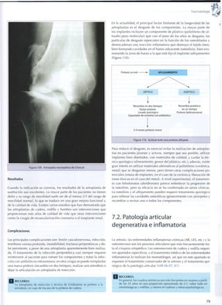Traumatología
Resultados
Cuando la indicación es correcta, los resultados de la artroplastia de
sustitución son excelentes. La mayor parte de los pacientes no tienen
dolor y su rango de movilidad suele ser de al menos 2/3 del rango de
movilidad normal, lo q u e se traduce en una gran mejora funcional y
de la calidad de vida. Existen varios estudios que han demostrado que
las artroplastias de cadera, rodilla y h o m b r o son intervenciones que
proporcionan más años de calidad de vida que otras intervenciones
c o m o la cirugía de revascularización coronaria o el trasplante renal.
Complicaciones
En la actualidad, el principal factor limitante de la longevidad de las
artroplastias es el desgaste de los componentes. La mayor parte de
los implantes incluyen un componente de plástico (polietileno de ul-
traalto peso molecular) que c o n el paso de los años se desgasta; las
partículas de desgaste repercuten en la función de los osteoblastos y
desencadenan una reacción inflamatoria q u e destruye el tejido óseo,
bien formando cavidades en el hueso adyacente (osteólisis), bien ero-
sionando la zona de hueso a la que está fijo el implante (aflojamiento)
(Figura 110).
Prótesis va mal - AFLOJ
FLOJAMIENTO
SÉPTICO
Recambio en dos tiempos
Quitar prótesis
Lavado quirúrgico
Espaciador de cemento con antibiótico
3-4 meses prótesis nueva
ASEPTICO
Recambio protésico
en un tiempo
Prótesis bidimensional
Figura 110. Actitud ante una prótesis aflojada
Para reducir el desgaste, es esencial evitar la realización de artroplas-
tias en pacientes jóvenes y activos, siempre que sea posible, utilizar
implantes bien diseñados, c o n materiales de calidad, y cuidar la téc-
nica quirúrgica (alineamiento, grosor del plástico, etc.); además, existe
gran interés en utilizar materiales alternativos al polietileno (cerámica,
metal) q u e se desgastan menos, pero tienen otras complicaciones p o -
tenciales (rotura de implantes, en el caso de la cerámica; liberación de
iones tóxicos en el caso del metal). A nivel experimental, el tratamien-
to con bifosfonatos (alendronato) parece enlentecer la progresión de
la osteólisis, pero su eficacia no se ha confirmado en series clínicas.
La osteólisis y el aflojamiento pueden requerir tratamiento quirúrgico
para rellenar las cavidades osteolíticas (generalmente c o n aloinjerto) y
recambiar o revisar uno o todos los componentes.
7.2. Patología articular
degenerativa e inflamatoria
Las principales complicaciones son: lesión vasculonerviosa, infección,
trombosis venosa profunda, inestabilidad, fracturas periprotésicas y d o -
lor persistente, a pesar de una artroplastia aparentemente bien realiza-
da. El tratamiento de la infección periprotésica casi siempre requiere
reintervenir al paciente para extraer los componentes y tratar la infec-
ción con antibióticos intravenosos; en otra cirugía se puede reimplantar
una nueva prótesis (recambio en dos tiempos), realizar una artrodesis o
dejar la articulación en artroplastia de resección.
RECUERDA
La artroplastia de resección o técnica d e Cirdlestone se prefiere a la
artrodesis, en caso de fracaso de la prótesis de cadera.
La artrosis, las enfermedades inflamatorias crónicas (AR, LES, etc.) y la
osteonecrosis son los procesos articulares q u e más frecuentemente tra-
ta el cirujano ortopédico. Las osteonecrosis de cadera y rodilla requie-
ren apartados específicos, y el tratamiento médico de las enfermedades
inflamatorias lo realizan los reumatólogos, así que en este apartado se
exponen el tratamiento conservador de la artrosis y el tratamiento q u i -
rúrgico de la patología articular (MIR 06-07, 87).
RECUERDA
En general, los cuadros artrósicos son más frecuentes e n mujeres a partir
de los 55 años en una proporción aproximada de 2 : 1 , sobre t o d o en
interfalángicas y rodillas, y menos en caderas y metacarpofalángicas.
79
 
