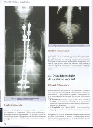 M a n u a l C T O d e M e d i c i n a y Cirugía, 8.a
edición
Figura 127. Imagen de cirugía de escoliosis estabilizada
(artrodesis con barras y tornillos)
Escoliosis congénita
Se asocia a otras malformaciones congénitas cardíacas, genitourina-
rias y neurológicas, que requieren la realización de ecocardiografía,
ecografía urinaria y resonancia magnética de la columna para su de-
tección. La mayor parte de los casos progresan y requieren tratamiento
quirúrgico (hemifusión vertebral o instrumentación sin artrodesis, Fi-
gura 128).
Figura 128. Escoliosis congénita secundaria a hemivértebra
Escoliosis neuromuscular
La calidad de v i d a de los pacientes c o n enfermedades neuromuscu-
lares empeora e n o r m e m e n t e c o n el desarrollo de escoliosis. Estos
pacientes desarrollan una curva larga en C c o n colapso del t r o n c o
que i m p i d e la sedestación y el m a n t e n i m i e n t o del e q u i l i b r i o . M u -
chos de estos pacientes toleran mal los corsés, especialmente si
no tienen una buena sensibilidad. Es r e c o m e n d a b l e la realización
de una artrodesis en cuanto el paciente alcanza el desarrollo sufi-
ciente.
8.3. Otras deformidades
de la columna vertebral
Cifosis de Scheuermann
D e f o r m i d a d estructural (rígida) de la c o l u m n a dorsal y/o lumbar
en el p l a n o sagital, c o n a u m e n t o de cifosis y c a m b i o s radiológicos
característicos. Es más frecuente en varones, y suele diagnosticar-
se en la adolescencia. Su etiología es desconocida, existiendo dos
formas:
• La forma dorsal puede tener el ápex (o vértice de la deformidad)
en D7-D9 o en la unión dorsolumbar (D11-D12). Estos pacientes
suelen consultar por deformidad y tienen molestias en aproximada-
mente el 2 0 % de los casos.
La forma lumbar tiene el ápex en L1-L2, y suelen consultar fun-
damentalmente por dolor ( 8 0 % de los casos) que aumenta con la
actividad.
En la exploración, la cifosis se hace especialmente evidente con el test
de Adams. A diferencia de los pacientes con cifosis postural del ado-
lescente, la cifosis de Scheuermann no se corrige cuando el paciente
intenta hiperextender la columna.
9 2
 