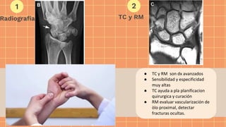 ● Radiografía AP y Lateral.
● Oblicua en pronación 45 a 60º.
● Px con RX -, sign y sint clínicos
relacionados con fractura de escafoides:
● Colocar al paciente en un brazo de yeso
corto en espiga para el pulgar y obtener
radiografías repetidas a los 10 a 14 días.
● La segunda opción es obtener imágenes
avanzadas (TC, RM) para descartar una
fractura de escafoides.
● TC y RM son dx avanzados
● Sensibilidad y especificidad
muy altas
● TC ayuda a pla planificacion
quirurgica y curación
● RM evaluar vascularización de
òlo proximal, detectar
fracturas ocultas.
Radiografia
1 2
TC y RM
 