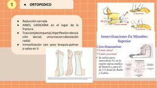 ● Reducción cerrada
● AINES, LIDOCAÍNA en el lugar de la
fractura
● Traccion(desimpacta),Hiperflexión=desvia
ción dorsal, ulnarizacion=desviación
radial.
● Inmovilización con yeso braquio-palmar
o valva en U
1 ● ORTOPEDICO
 