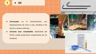 ● Artroscopia: en fx intraarticulares con
desplazamiento de 1mm o más, alambres K de
0,5mm y tutores externos.
● Cemento óseo remodelable: efectividad del
81,5%, puede presentarse atrapamiento de los
tendones.
1 ● QX
 