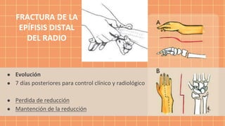 ● Evolución
● 7 días posteriores para control clínico y radiológico
● Perdida de reducción
● Mantención de la reducción
FRACTURA DE LA
EPÍFISIS DISTAL
DEL RADIO
 