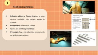 ● Reducción abierta y fijación interna: se usan
tornillos canulados, tipo Herbert, agujas de
kirschner.
● Reabsorbibles: tornillos sin cabeza.
● Fijación con tornillos percutáneos
● Artroscopia: hay o no reducción, complementa
con la técnica percutánea.
Técnicas quirúrgicas
1
 
