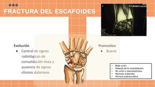 Evolución
● Control de signos
radiológicos de
consolidación ósea y
ausencia de signos
clínicos dolorosos.
Pronostico
● Bueno
• Mala unión.
• Retardo de la consolidación.
• No unión o pseudoartrosis.
• Necrosis avascular.
• Artrosis postraumática.
FRACTURA DEL ESCAFOIDES
 