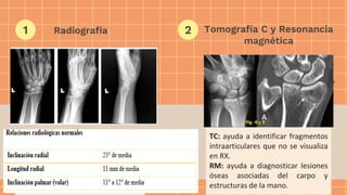 Radiografia
● Confirmar la lesion.
● Altura radial, inclinacion radial,
variacion cubital, inclinación y
desplazamiento radial
● Proyección AP y Lateral de
muñeca.
Tomografía C y Resonancia
magnética
TC: ayuda a identificar fragmentos
intraarticulares que no se visualiza
en RX.
RM: ayuda a diagnosticar lesiones
óseas asociadas del carpo y
estructuras de la mano.
1 2
 