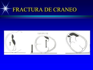 FRACTURA DE CRANEO
 