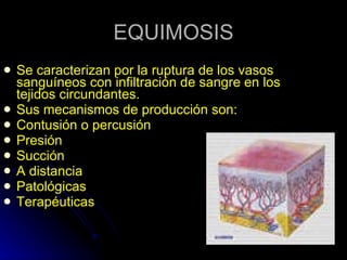 EQUIMOSIS Se caracterizan por la ruptura de los vasos sanguíneos con infiltración de sangre en los tejidos circundantes. Sus mecanismos de producción son: Contusión o percusión Presión Succión A distancia Patológicas Terapéuticas 