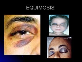 EQUIMOSIS  