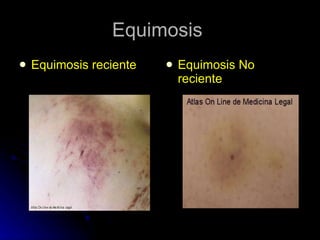 Equimosis  Equimosis reciente Equimosis No reciente 