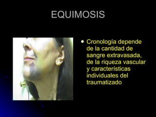 EQUIMOSIS Cronología depende de la cantidad de sangre extravasada, de la riqueza vascular y características individuales del traumatizado 