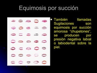 Equimosis por succión También llamadas Sugilaciones son equimosis por succión amorosa “chupetones”, se producen por presión negativa labial o labiodental sobre la piel. 