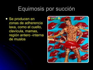 Equimosis por succión Se producen en zonas de adherencia  laxa, como el cuello, clavícula, mamas, región antero -interna de muslos 