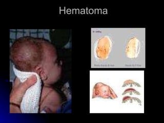 Hematoma  