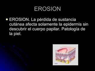 EROSION EROSION. La pérdida de sustancia cutánea afecta solamente la epidermis sin descubrir el cuerpo papilar. Patología de la piel. 