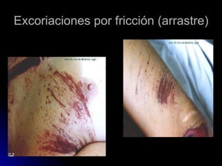 Excoriaciones por fricción (arrastre) 