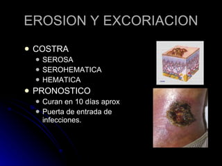 EROSION Y EXCORIACION COSTRA SEROSA SEROHEMATICA HEMATICA PRONOSTICO Curan en 10 días aprox Puerta de entrada de infecciones. 
