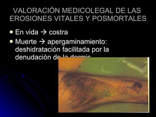 VALORACIÓN MEDICOLEGAL DE LAS  EROSIONES VITALES Y POSMORTALES En vida    costra Muerte    apergaminamiento: deshidratación facilitada por la denudación de la dermis 