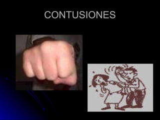 CONTUSIONES 