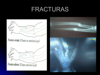 FRACTURAS 