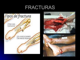 FRACTURAS 