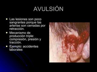AVULSIÓN Las lesiones son poco sangrantes porque las arterias son cerradas por retracción. Mecanismo de producción triple: compresión, presión y tracción. Ejemplo: accidentes laborales 