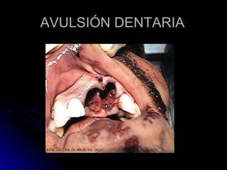 AVULSIÓN DENTARIA 