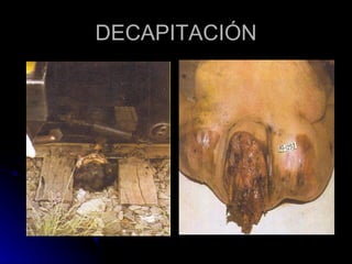 DECAPITACIÓN 