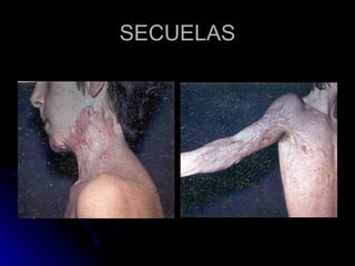 SECUELAS 