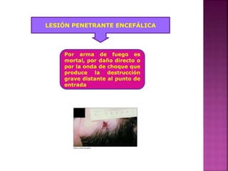 LESIÓN PENETRANTE ENCEFÁLICA
Por arma de fuego es
mortal, por daño directo o
por la onda de choque que
produce la destrucción
grave distante al punto de
entrada
 