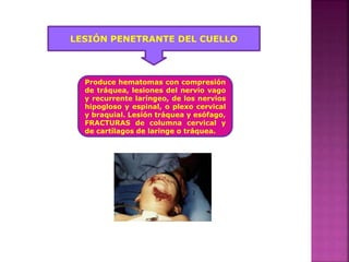 LESIÓN PENETRANTE DEL CUELLO
Produce hematomas con compresión
de tráquea, lesiones del nervio vago
y recurrente laríngeo, de los nervios
hipogloso y espinal, o plexo cervical
y braquial. Lesión tráquea y esófago,
FRACTURAS de columna cervical y
de cartílagos de laringe o tráquea.
 