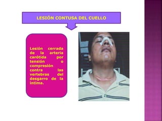 LESIÓN CONTUSA DEL CUELLO
Lesión cerrada
de la arteria
carótida por
tensión o
compresión
contra las
vertebras del
desgarro de la
íntima.
 