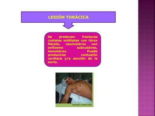 LESIÓN TORÁCICA
Se producen fracturas
costales múltiplas con tórax
flácido, neumotórax con
enfisema subcutáneo,
hemotórax. Puede
producirse contusión
cardiaca y/o sección de la
aorta.
 