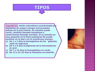 TIPOS
EQUIMOSIS: lesión subcutánea caracterizada por
depósitos de sangre (sangre extravasada)
debajo de la piel intacta. Su tamaño puede
variar, también llamado hematoma o
comúnmente llamado moretón. Si su tamaño es
muy pequeño se le llama petequias Se puede
localizar en la piel o en la membrana mucosa.
a) De 1 a 2 días la hemoglobina de los ´glóbulos
rojos es negruzca.
b) De 4 a 6 días el pigmento de la hemosiderina
es azul.
c) De 7 a 12 días la hemoglobina es verde.
d) De 13 a 21-22 días la hematina es amarillo.
 