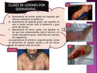 A. Quemaduras de primer grado son aquellas que
afectan solamente la epidermis.
B. Quemaduras de segundo grado ,son aquellas en
que la lesión incluye toda la epidermis y gran
parte del dermis.
C. Quemaduras de tercer grado, son aquellas en
las que esta comprometida todo el dermis y el
tejido subcutáneo graso, destruido por necrosis
de coagulación.
Las quemaduras d3 primero y segundo grado, juntas
se denominan de espesor parcial y las de tercer
grado de espesor total de la piel.
1º
2º
3º
CLASES DE LESIONES POR
QUEMADURAS..
1º y 2º
 