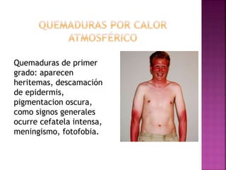 Quemaduras de primer
grado: aparecen
heritemas, descamación
de epidermis,
pigmentacion oscura,
como signos generales
ocurre cefatela intensa,
meningismo, fotofobia.
 