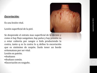Excoriación:
Es una lesión vital.
Lesión superficial de la piel.
Se desprende el estrato mas superficial de la dermis y
como si hay flujo sanguíneo, hay pulso y hay presión va
a estar cubierta por sangre o linfa produciendo la
costra, tanto q es la costra lo q define la excoriación
que es sinónimo de raspón. Suele tener un borde
eritematoso por ser vital.
Lesión en patrón.
•Arañazos
•Arañazo común.
•Excoriación en rasguño.
septiembrede2015
27
 