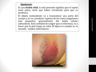 • Equimosis:
Es una lesión vital, si está presente significa que el sujeto
tenía pulso, tiene que haber circulación para que se
produzca.
El objeto contundente va a traumatizar una parte del
cuerpo y se va a producir ruptura de los vasos sanguíneos
más pequeños, generalmente del tejido celular
subcutáneo. Esta cantidad de sangre que se extravasa, va a
hacer que la piel tenga un color. El típico es cuando se ve
morado. –tejidos subcutáneos-
septiembrede2015
28
 