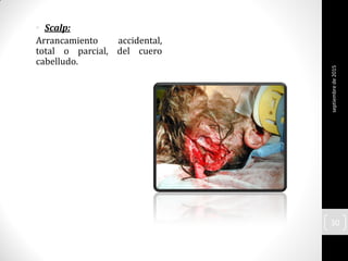 • Scalp:
Arrancamiento accidental,
total o parcial, del cuero
cabelludo.
septiembrede2015
30
 