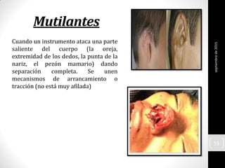 Mutilantes
Cuando un instrumento ataca una parte
saliente del cuerpo (la oreja,
extremidad de los dedos, la punta de la
nariz, el pezón mamario) dando
separación completa. Se unen
mecanismos de arrancamiento o
tracción (no está muy afilada)
septiembrede2015
55
 